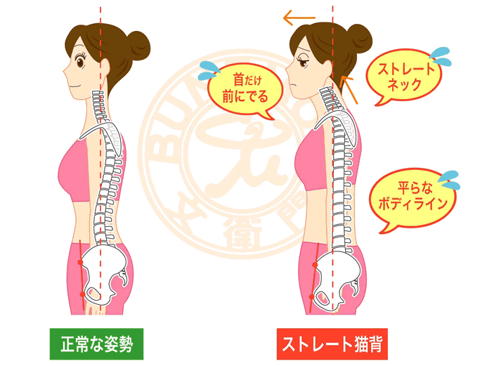 つじいの「猫背矯正（姿勢改善）」 | つじい鍼灸整骨院